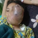 Satrawati, Sudah Empat Tahun Penderita Tumor Ganas Warga Jangkat Butuh Uluran Tangan
